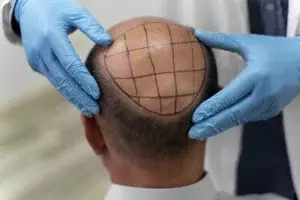 permanent-hair-removal-640x480-54230259.jpeg