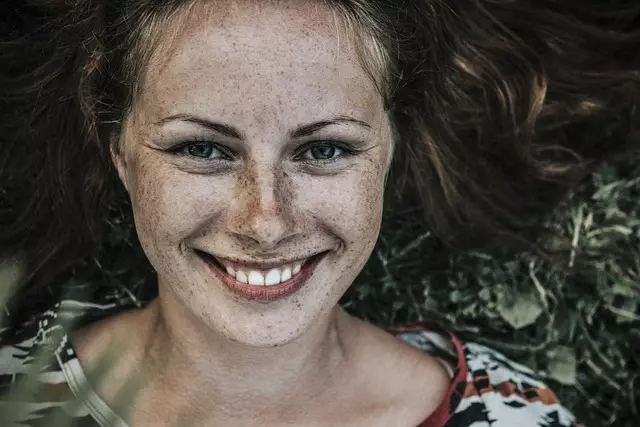 Botox for Crow’s Feet and Smile Lines