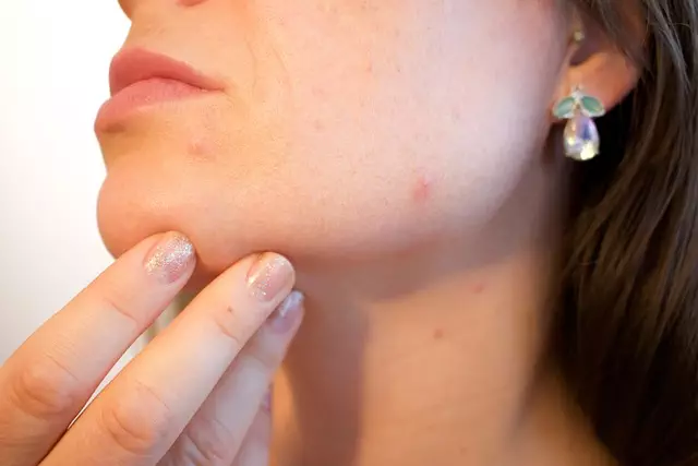 Acne Scar Reduction with Morpheus8