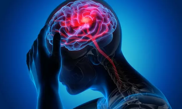 Botox for Migraine Relief