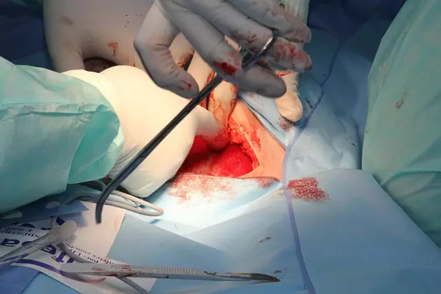 CoolSculpting Procedure