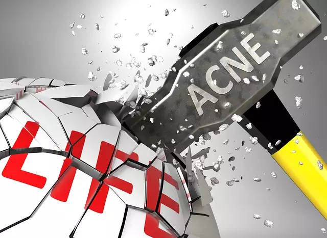acne-scar-reduction-with-morpheus8-640x480-91186723.jpeg
