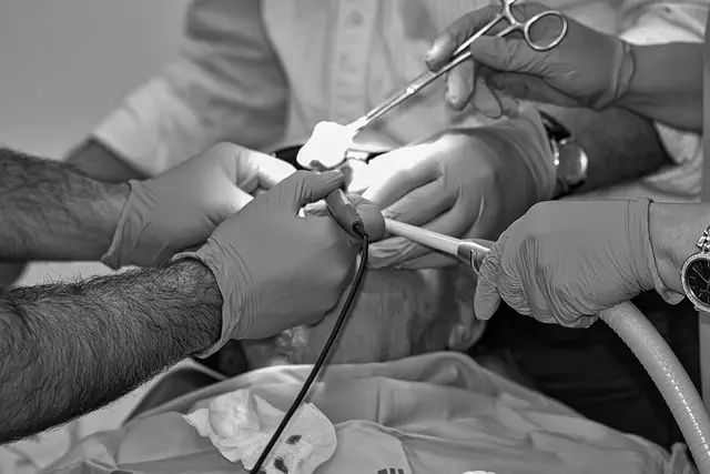 CoolSculpting Procedure